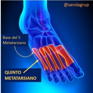 fractura-de-jones-1