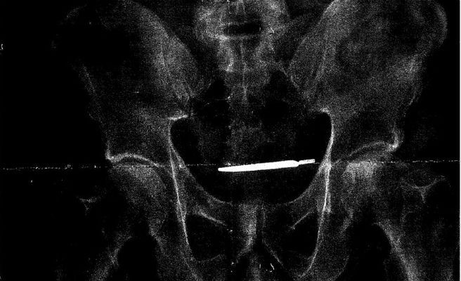 bisturi_656x400-672xXx80